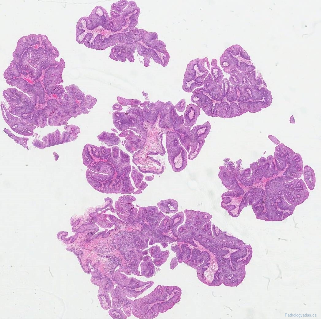 Laryngeal Papillomatosis Atlas Of Pathology