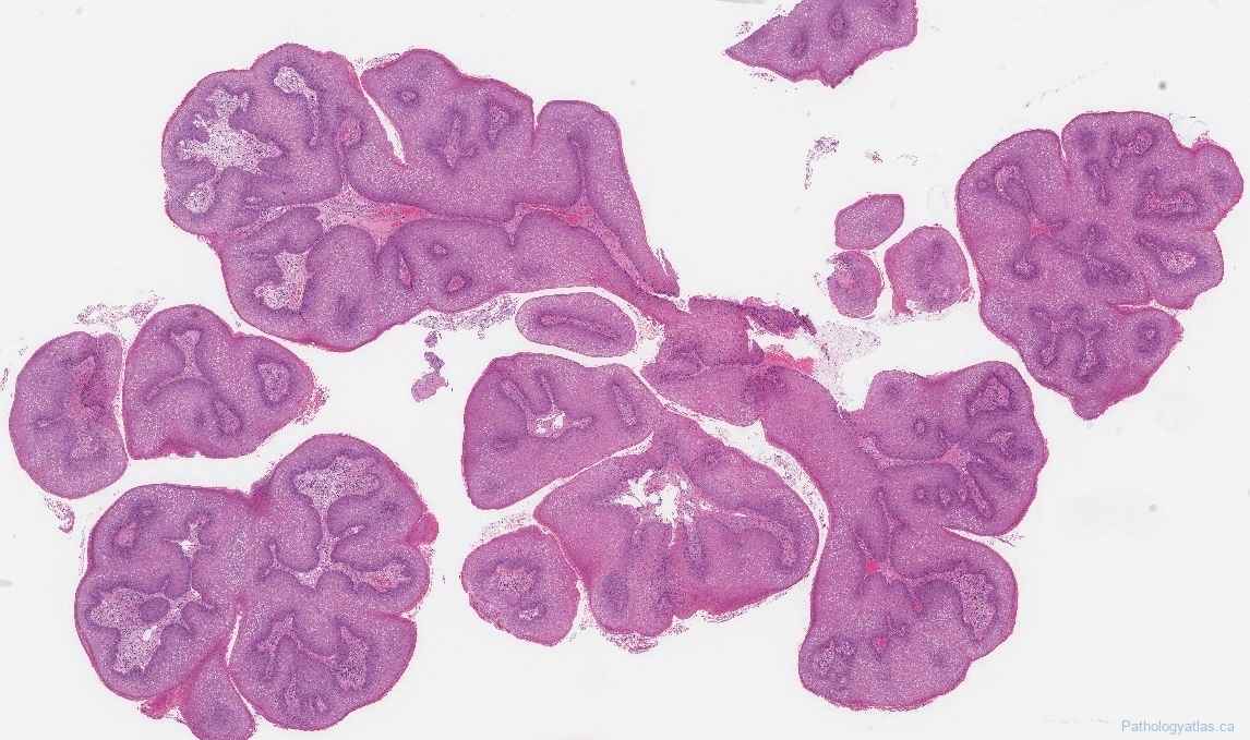 Laryngeal Papillomatosis Atlas Of Pathology