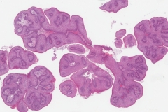 Laryngeal papillomatosis