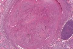 Leiomyoma of the ovary