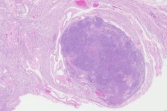 Leiomyoma of the uterus