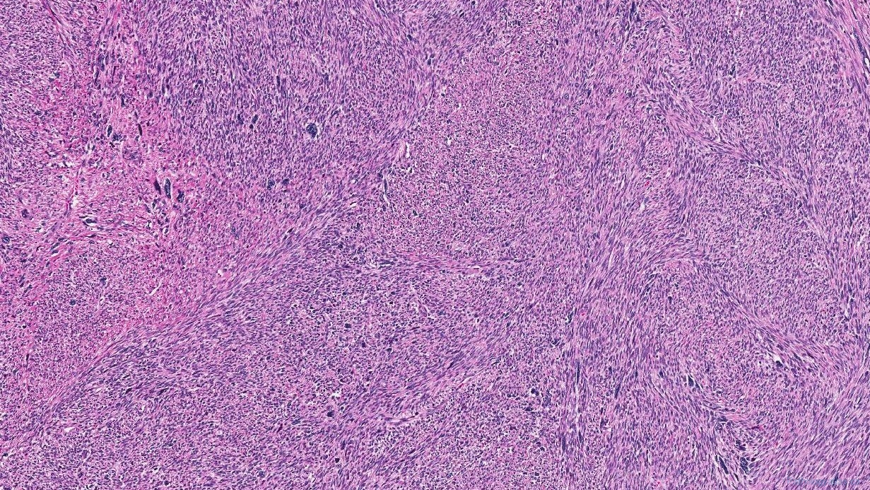 Leiomyoma | Atlas Of Pathology