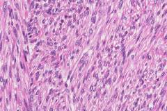 Leiomyosarcoma of the skin