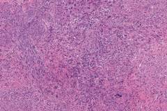 Leiomyosarcoma of the skin