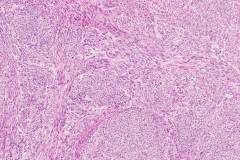 Leiomyosarcoma of the skin