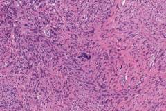 Leiomyosarcoma of the skin