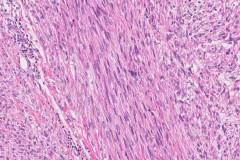 Leiomyosarcoma of the skin