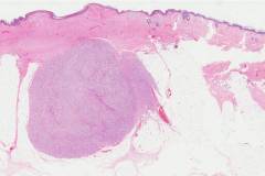 Leiomyosarcoma of the skin