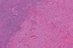 Leydig cell tumour of the ovary