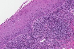 Lichenoid mucositis of the oral cavity