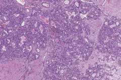 Lobular capillary hemangioma of the nasal cavity