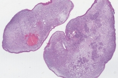 Lobular capillary hemangioma of the nasal cavity