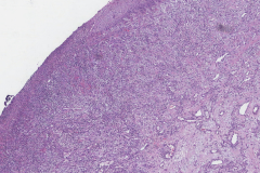 Lobular capillary hemangioma of the nasal cavity