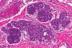 Lobular carcinoma in situ of the breast