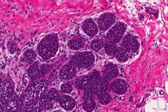 Lobular carcinoma in situ of the breast