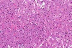 Lobular inflammation in the liver