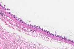 Low grade appendiceal mucinous neoplasm