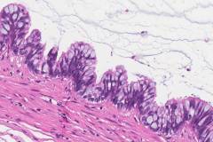 Low grade appendiceal mucinous neoplasm