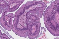 Metastatic low grade appendiceal mucinous neoplasm to the ovary