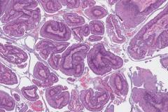 Metastatic low grade appendiceal mucinous neoplasm to the ovary