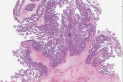 Metastatic low grade appendiceal mucinous neoplasm to the ovary