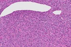 Low grade endometrial stromal sarcoma