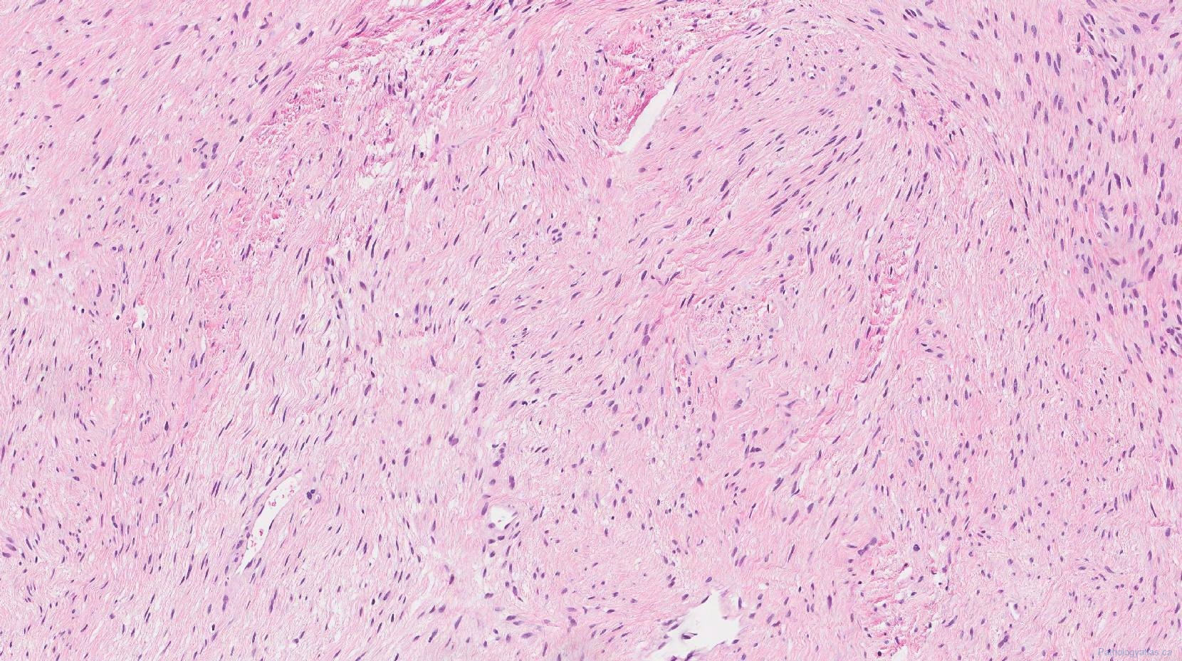 Low grade fibromyxoid sarcoma | Atlas of Pathology