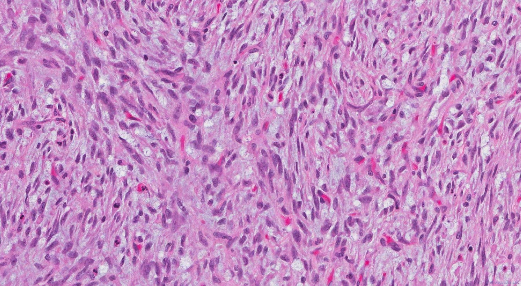 Low grade fibromyxoid sarcoma | Atlas of Pathology