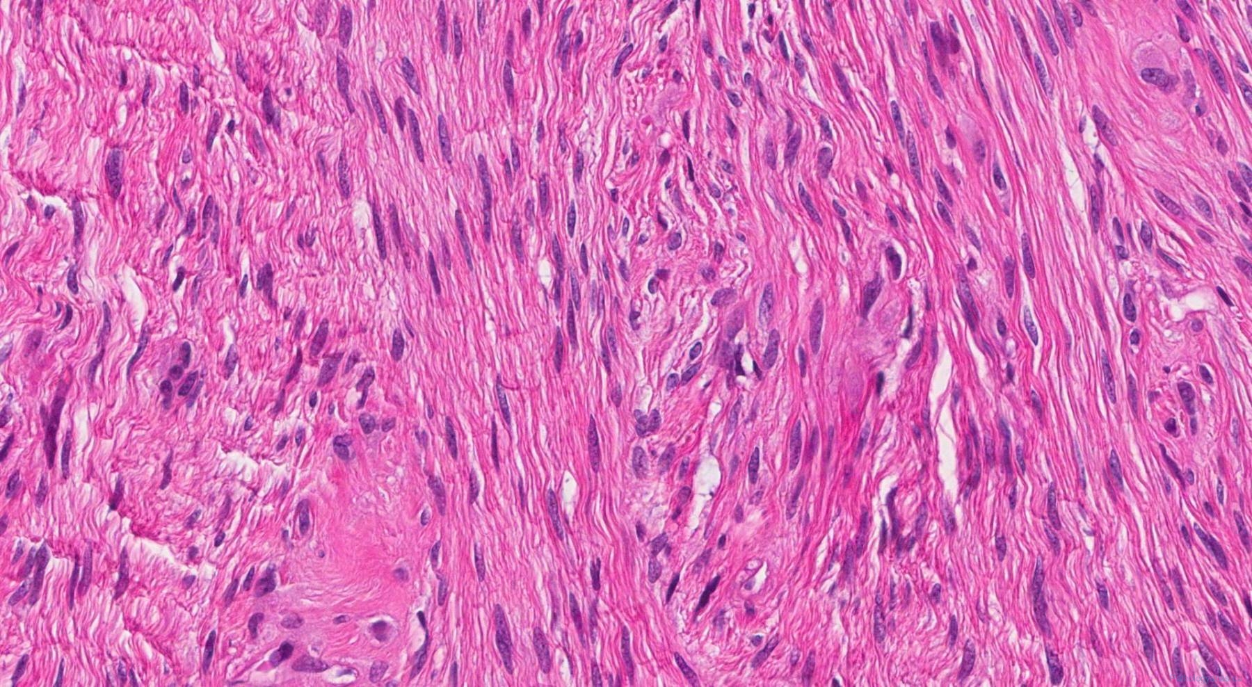 Low grade fibromyxoid sarcoma | Atlas of Pathology