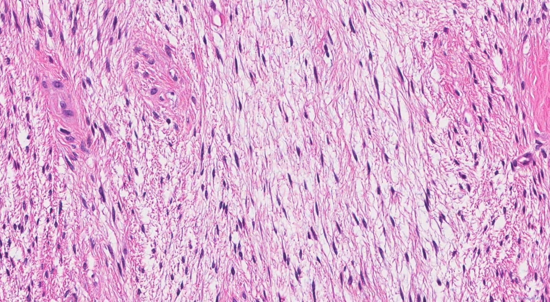 Low grade fibromyxoid sarcoma | Atlas of Pathology