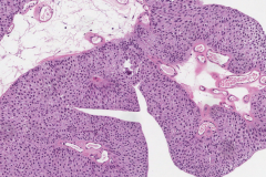 Low grade papillary urothelial carcinoma