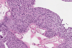 Low grade papillary urothelial carcinoma