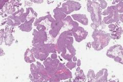 Low grade papillary urothelial carcinoma