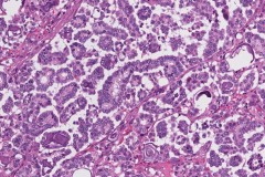 Low grade serous carcinoma of the ovary