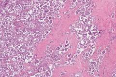 Low grade serous carcinoma of the ovary