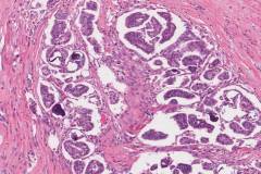 Low grade serous carcinoma of the ovary