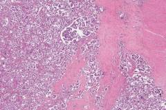 Low grade serous carcinoma of the ovary