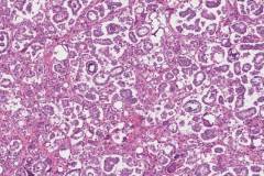 Low grade serous carcinoma of the ovary