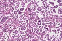 Low grade serous carcinoma of the ovary