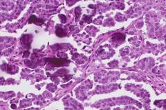 Low grade serous carcinoma of the ovary