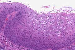 Low grade squamous intraepithelial lesion of the anal canal