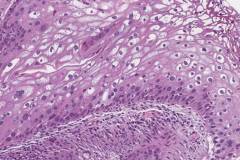 Low grade squamous intraepithelial lesion of the cervix