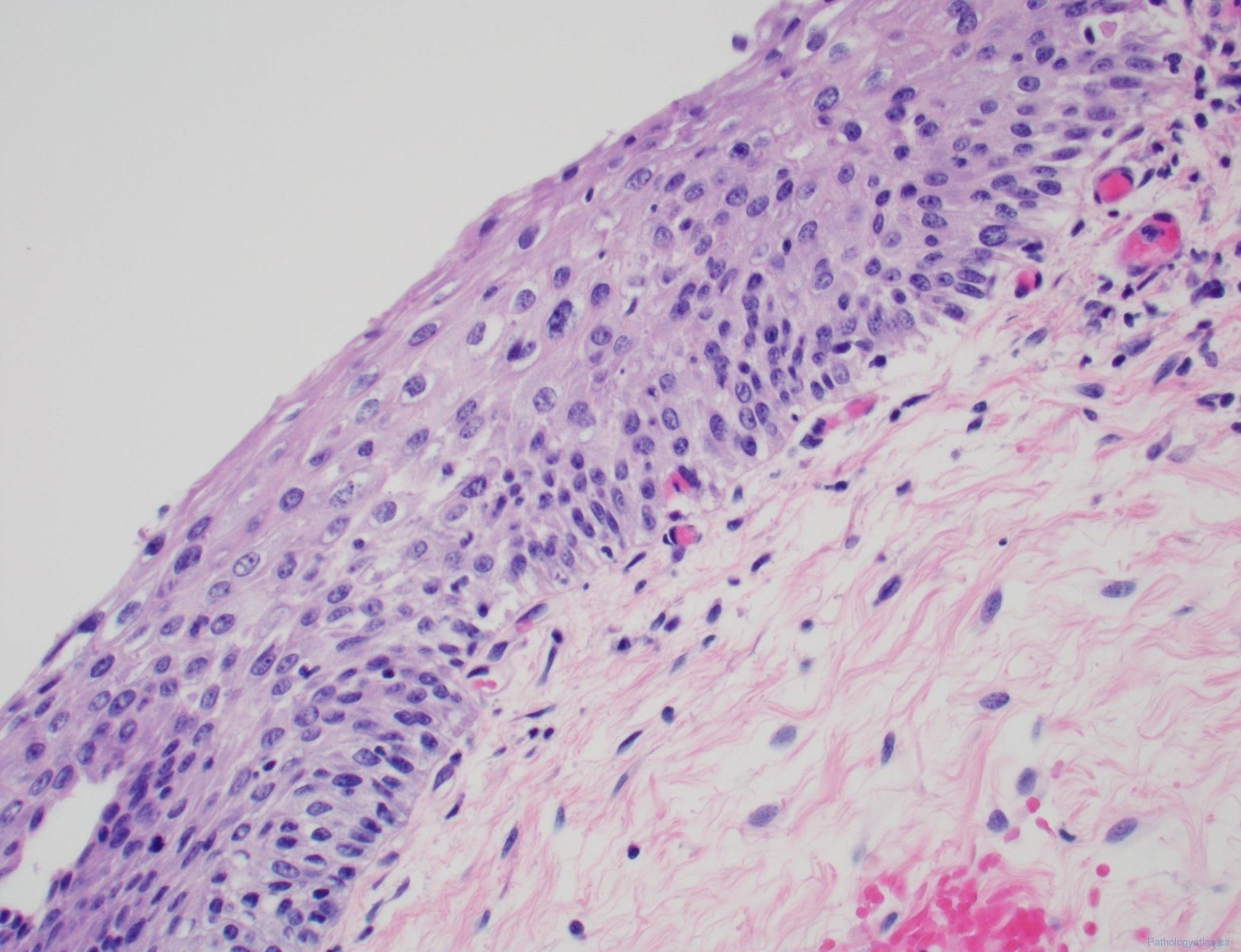 Low Grade Squamous Intraepithelial Lesion Of The Vagina Atlas Of Pathology 8915