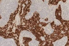 Lymphoepithelial carcinoma of the parotid gland: Immunohistochemistry for cytokeratin 5.