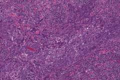 Lymphoepithelial carcinoma of the parotid gland