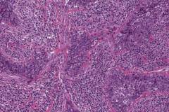 Lymphoepithelial carcinoma of the parotid gland