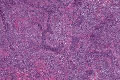 Lymphoepithelial carcinoma of the parotid gland