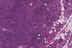 Lymphoepithelial carcinoma of the parotid gland