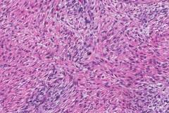 Malignant peripheral nerve sheath tumour with rhabdomyoblastic differentiation