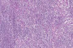 Malignant peripheral nerve sheath tumour with rhabdomyoblastic differentiation